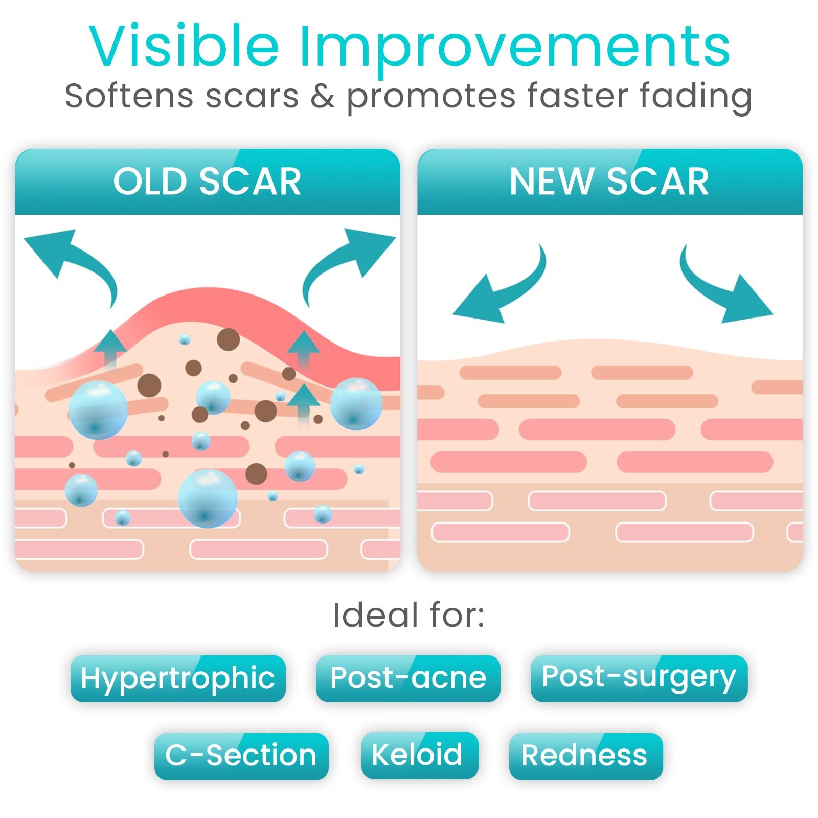 Vive Care Vivecare Silicone Scar Sheets Tape 1.6 X 120 Roll Medical Grade
