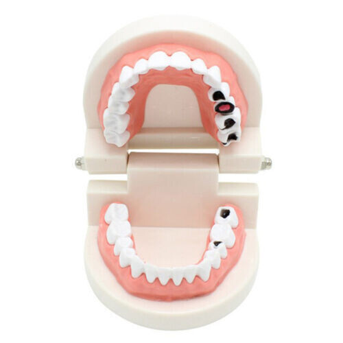 5 Pcs Dental High Quality Material Decay Standard Teeth Teach Adult Caries Model