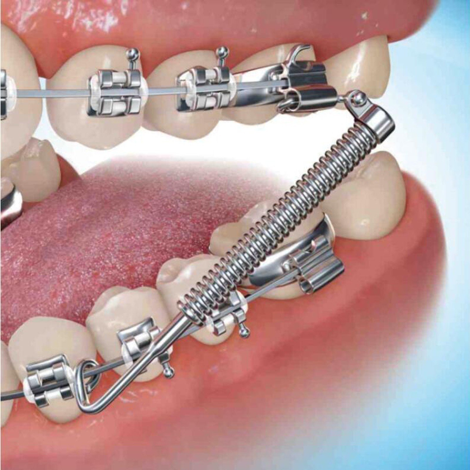 Orthodontic Dental Class II Malocclusion Appliances Fatigue Resistant Device