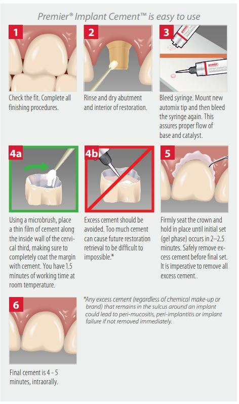 Premier Dental Implant Cement For Implant Retained crowns 5 mL Syringe + 8 Tips