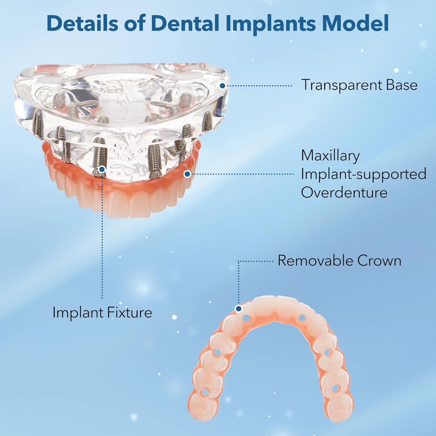 New Dental Implant Model All-on-4 All-on-6 Overdenture U/L Jaw 4/6 Screws Clear