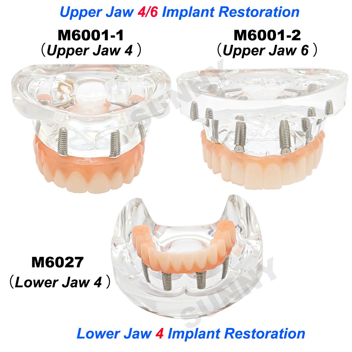 Dental Upper/Lower 4/6 Implants Demo Implant Teeth Model Restoration Overdenture