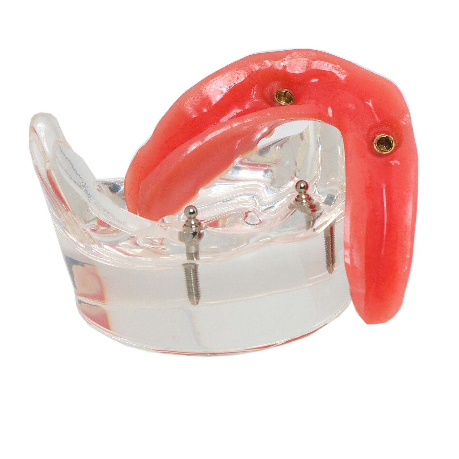 Dental Implant Model Upper Lower Jaw Demo All on 4/6 Overdenture treatment model