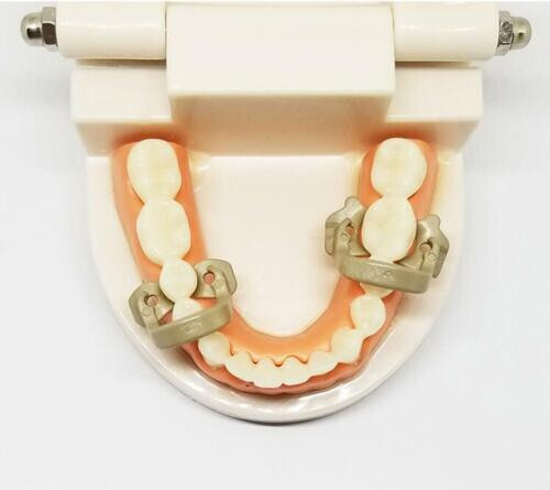 4 Pcs Dental Barrier Clips Rubber Dam Clamps Clip Soft Resin Kerr Style Molar
