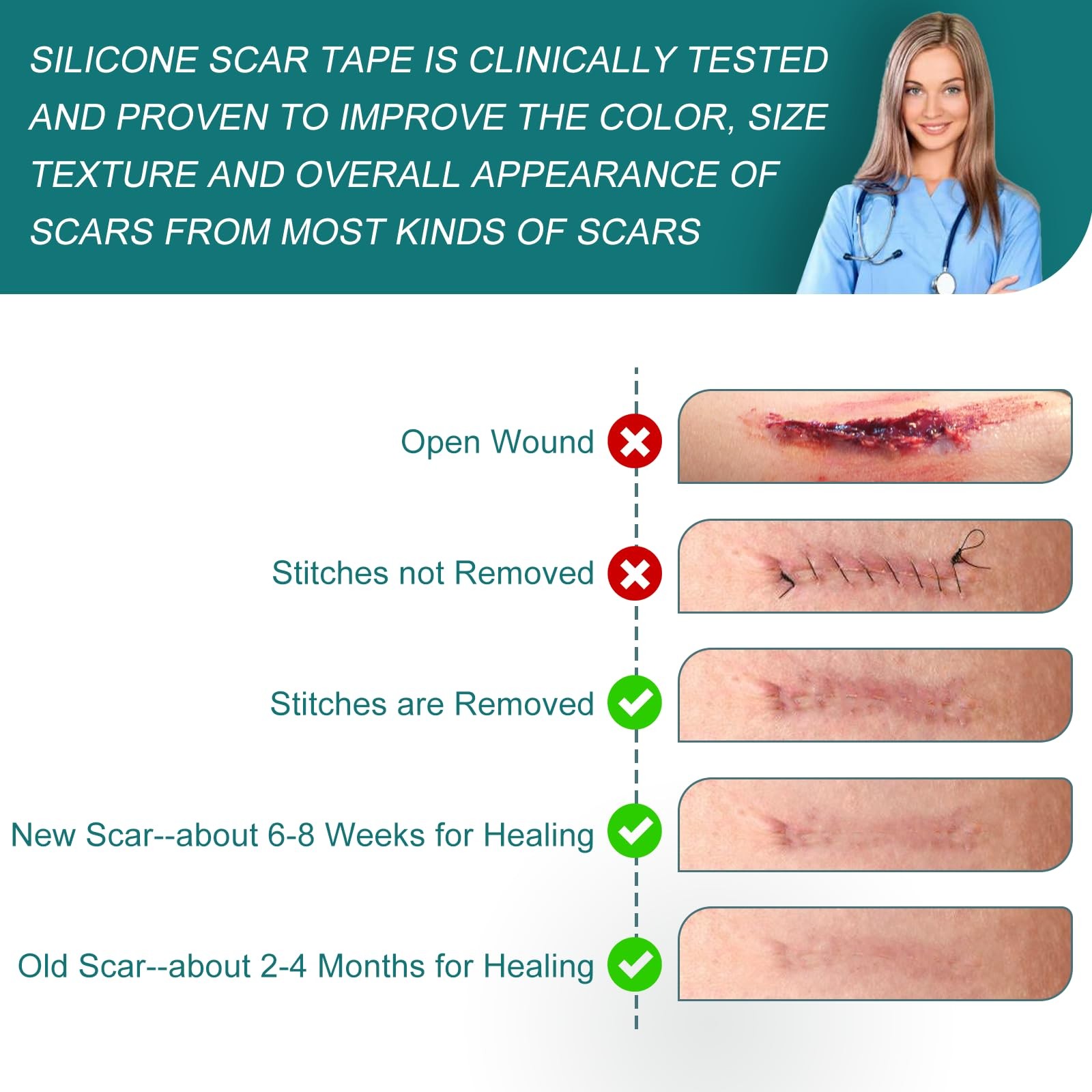 Silicone Scar Sheets (1.6″x 158″ Roll-4M), Medical Grade 1.6″×158″, no