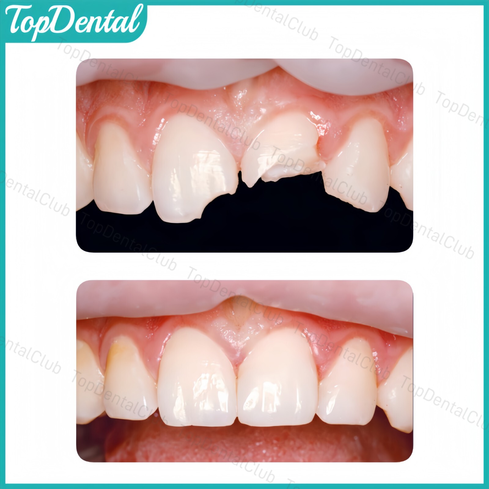 BLXL Dental Tetric N-Ceram Composite Resin BL XL Bleach Color Whitening Veneer