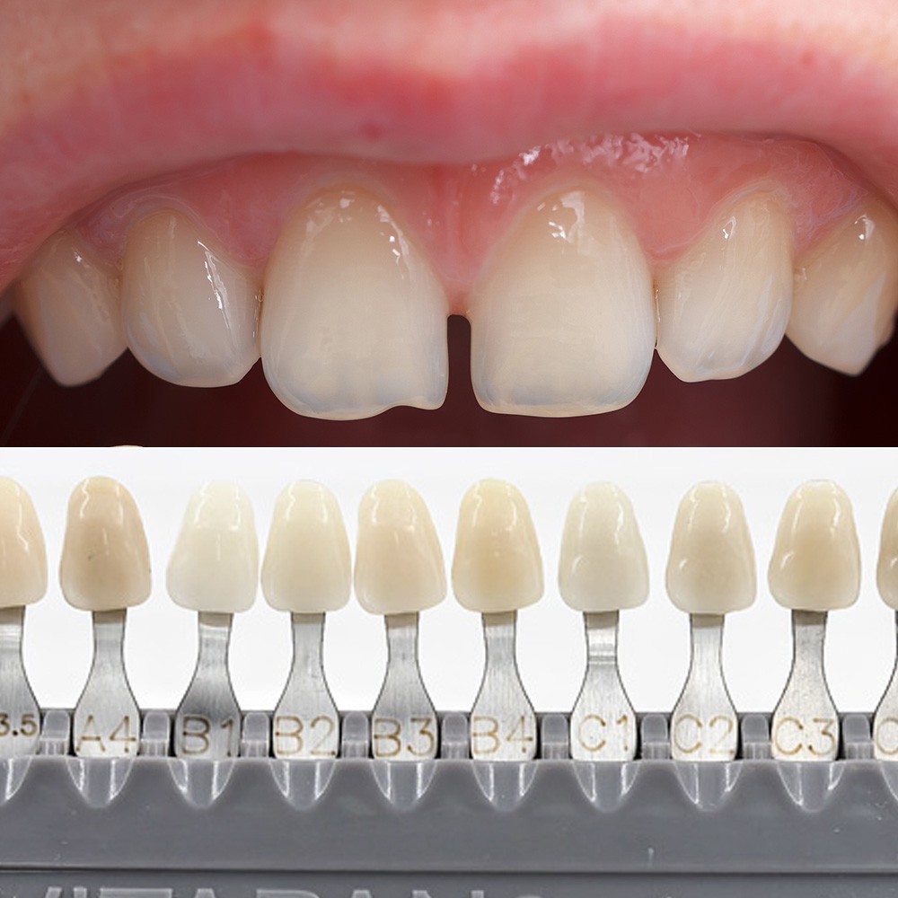 Vita Classical Shade Guide Dental Materials A1-D4 16 Colors Teeth Whitening