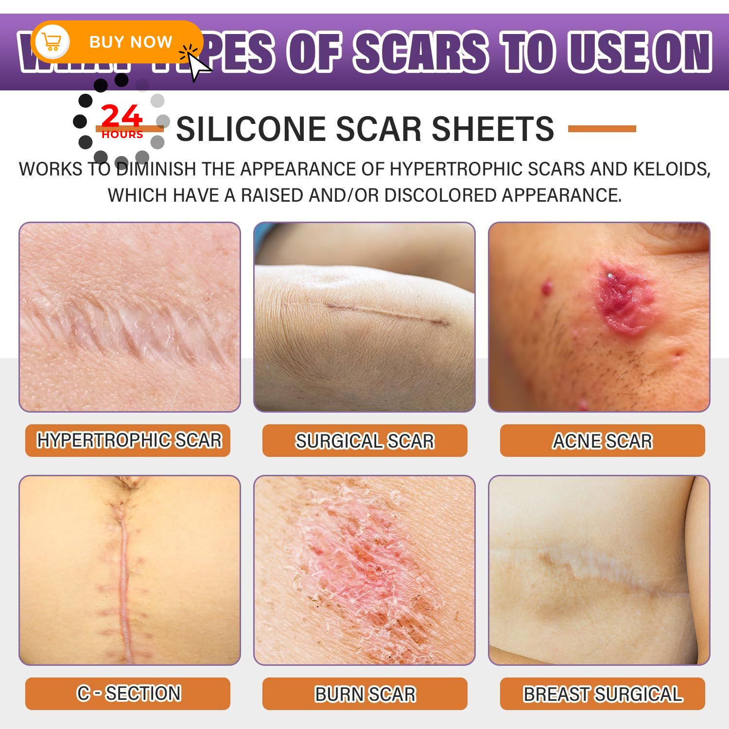 Silicone Scar Sheets, Medical Grade Tape for 3M, Beige