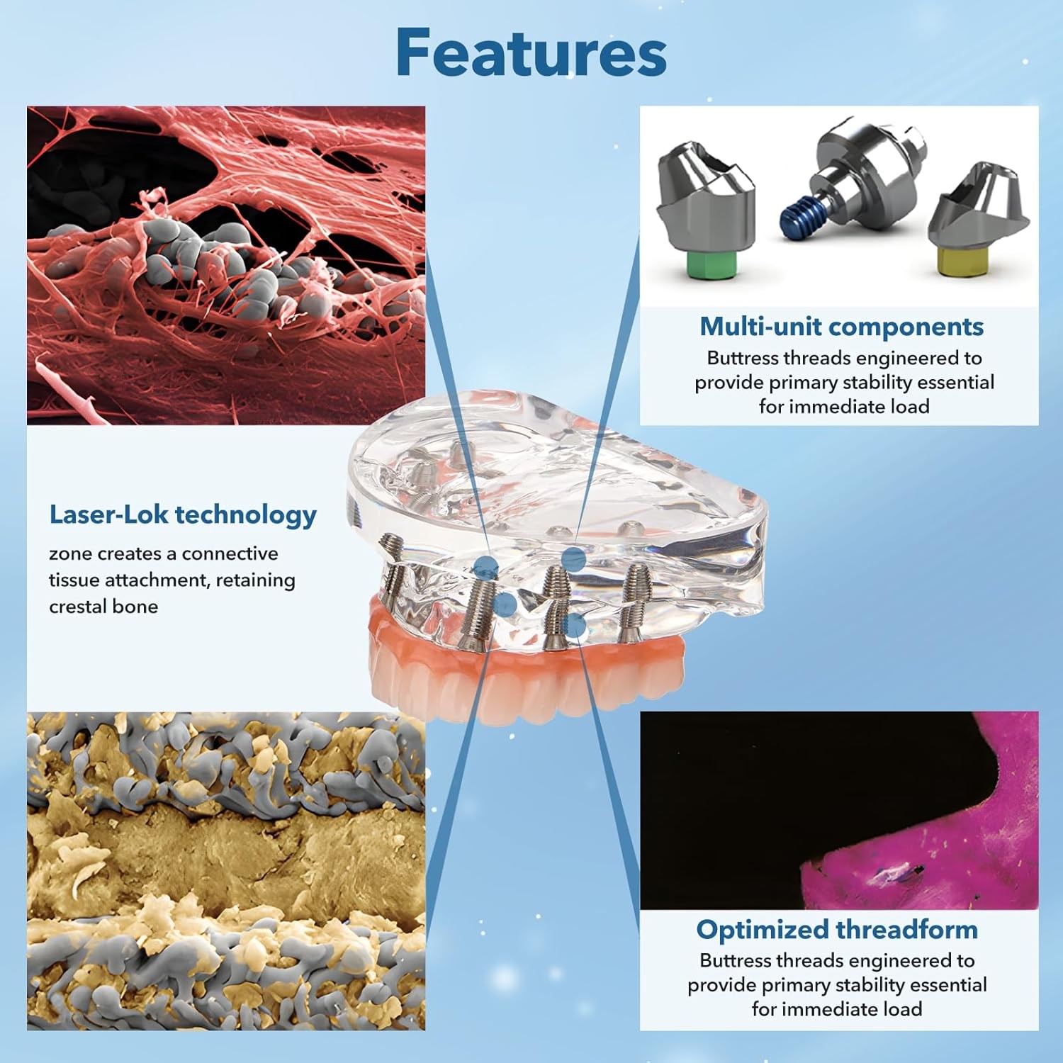 New Dental Implant Model All-on-4 All-on-6 Overdenture U/L Jaw 4/6 Screws Clear