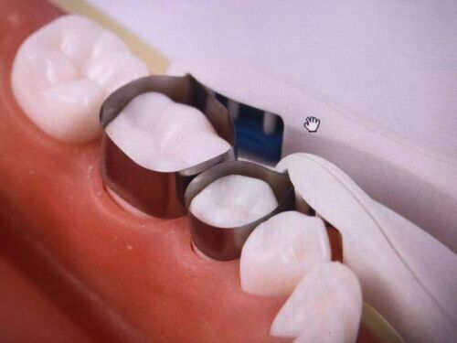 Adjust Dental Premolar Restoration Bands Metal Pro Matrix Bands Pre Formed