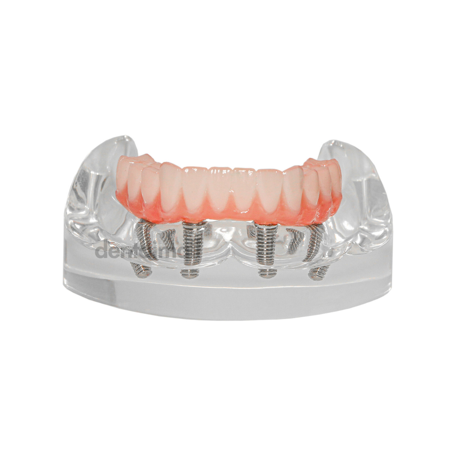 US Dental Overdenture Implant Model All-on-4 With 4 Screw Upper/Lower Clear Jaw