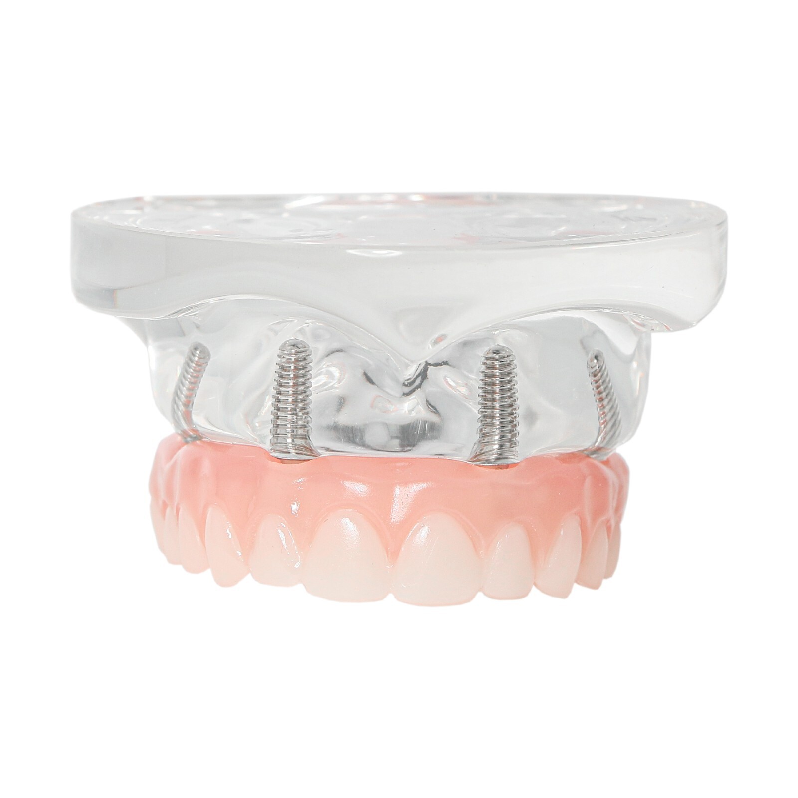 All-on-4/6 Screws Restoration Overdenture Dental Implant Model Upper/Lower Jaw