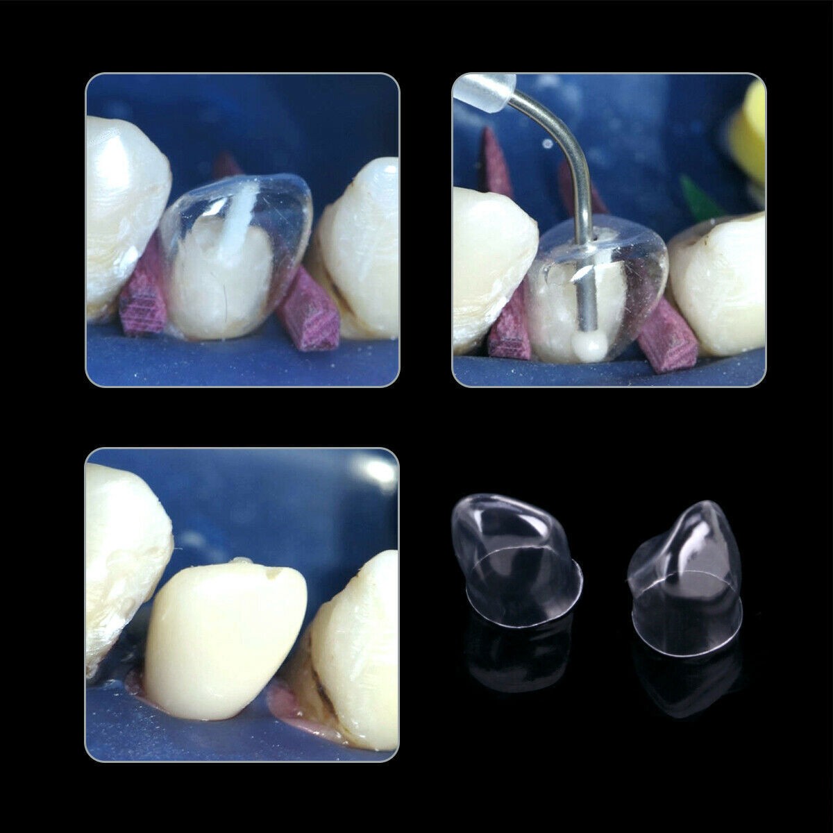 Dental Preformed Crown Resin Temporary Pre-corona Transparent Anterior Molar
