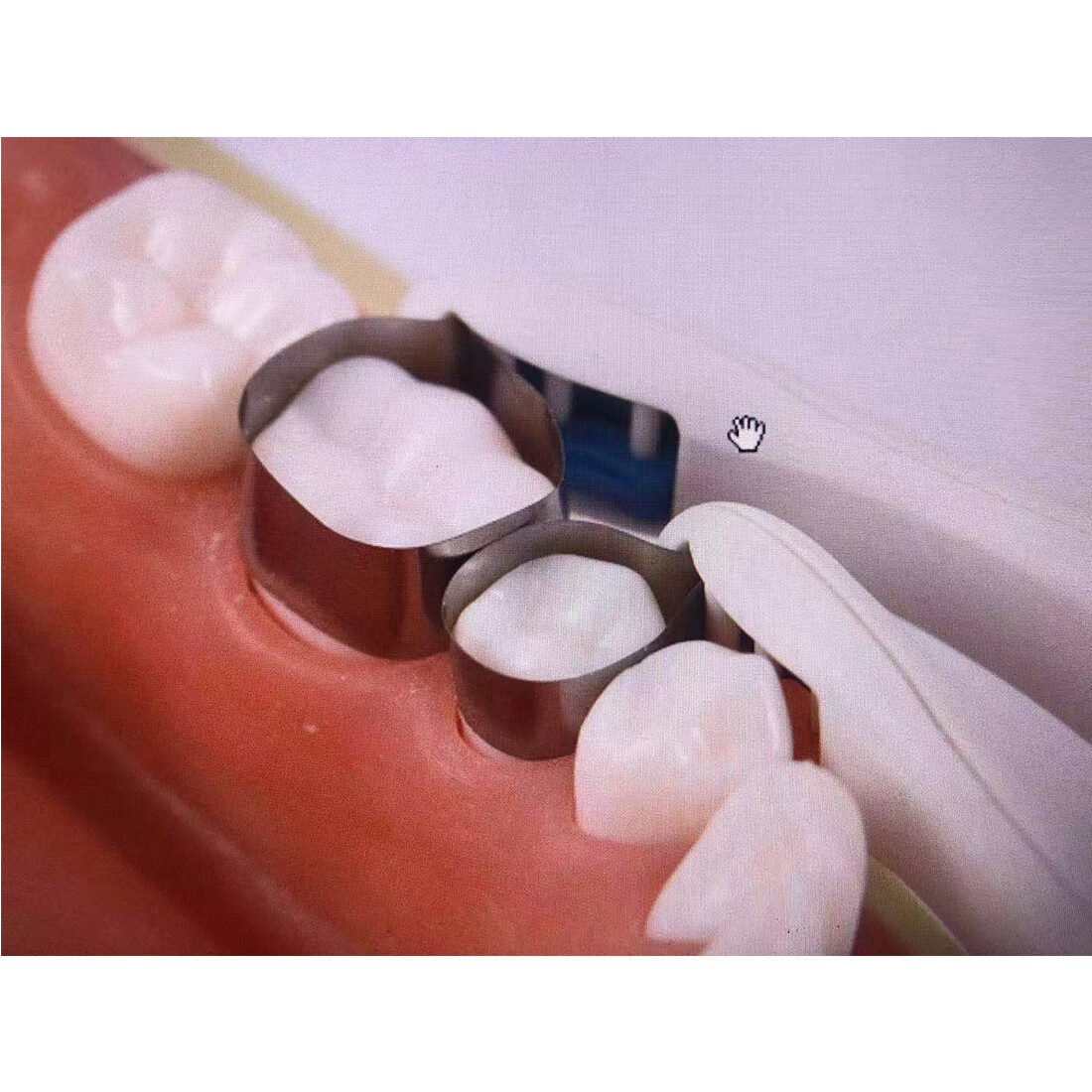 Dental Metal Pro Matrix Bands Premolar Pediatric Sectional Contoured Band 4.5MM