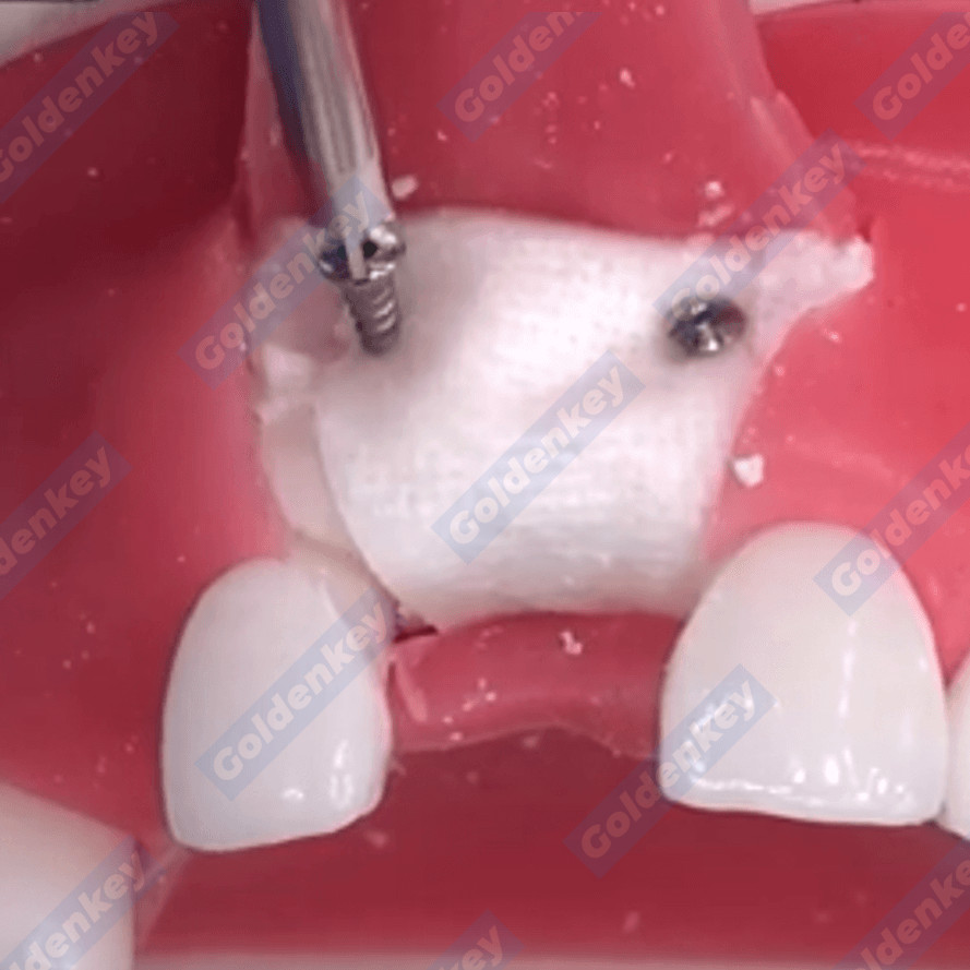 Dental GBR Bone Tent Screw Driver Tenting Fixation Guide Regeneration Membrane