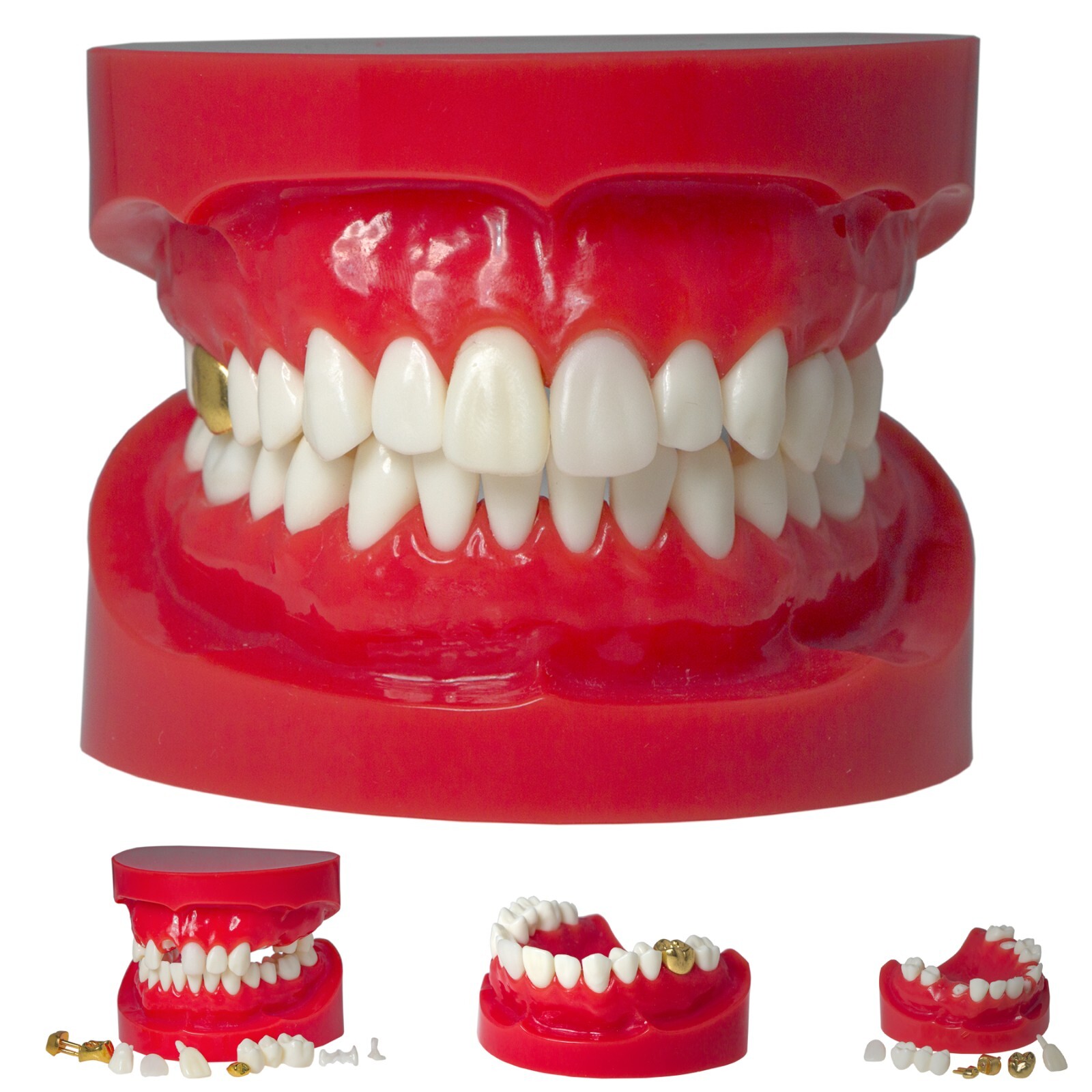 Dental Implant Model Upper Lower Jaw Demo All on 4/6 Overdenture treatment model