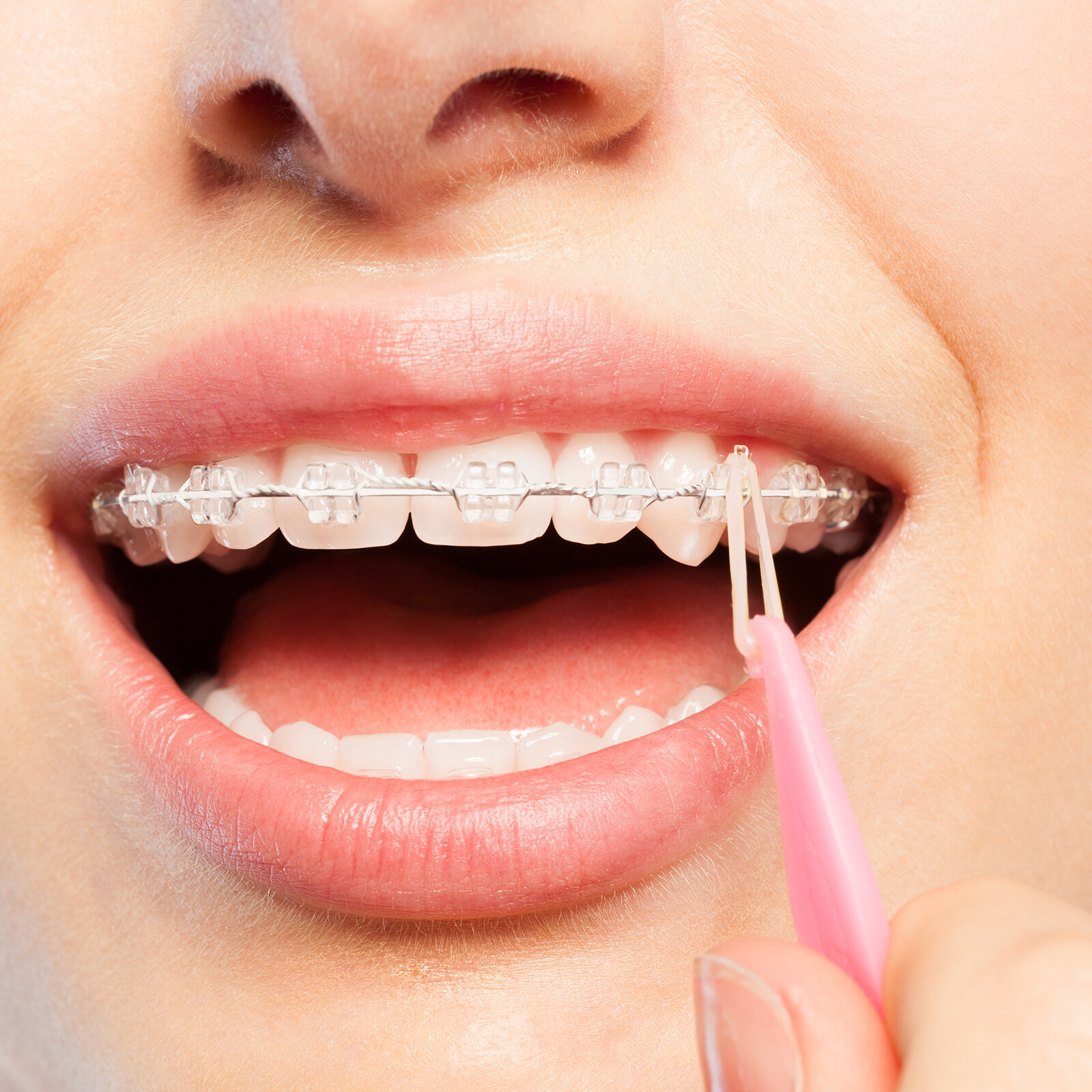 Close Teeth Gaps Orthodontic Intraoral Elastic Bands Latex-Free Made In USA