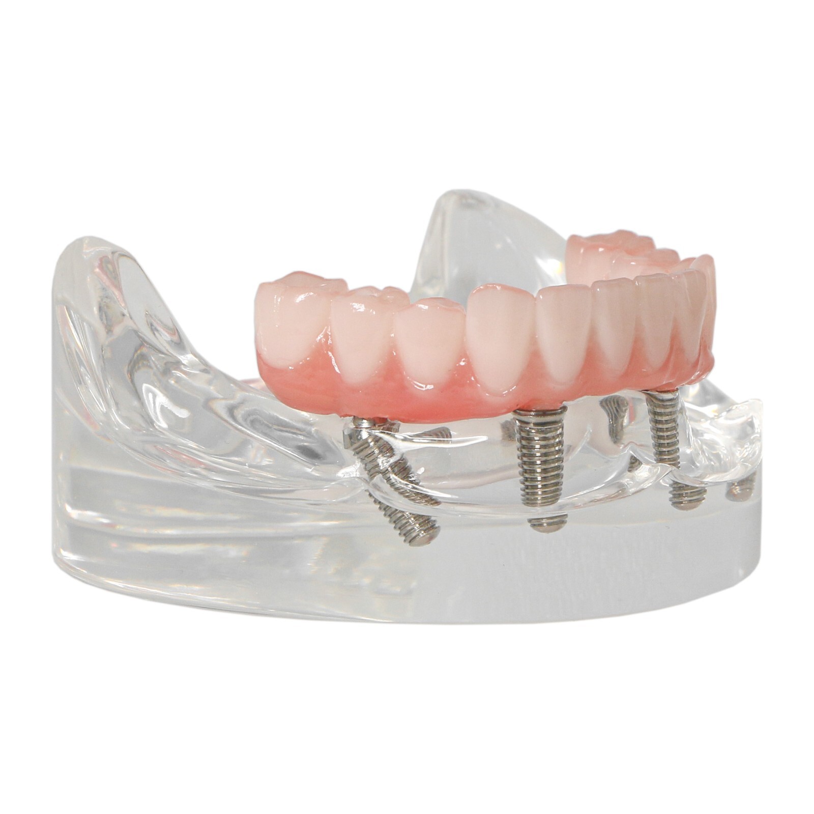 Dental All-on-4 Overdenture Implant Model, Upper/Lower Jaw-Clear,With 4 Screw