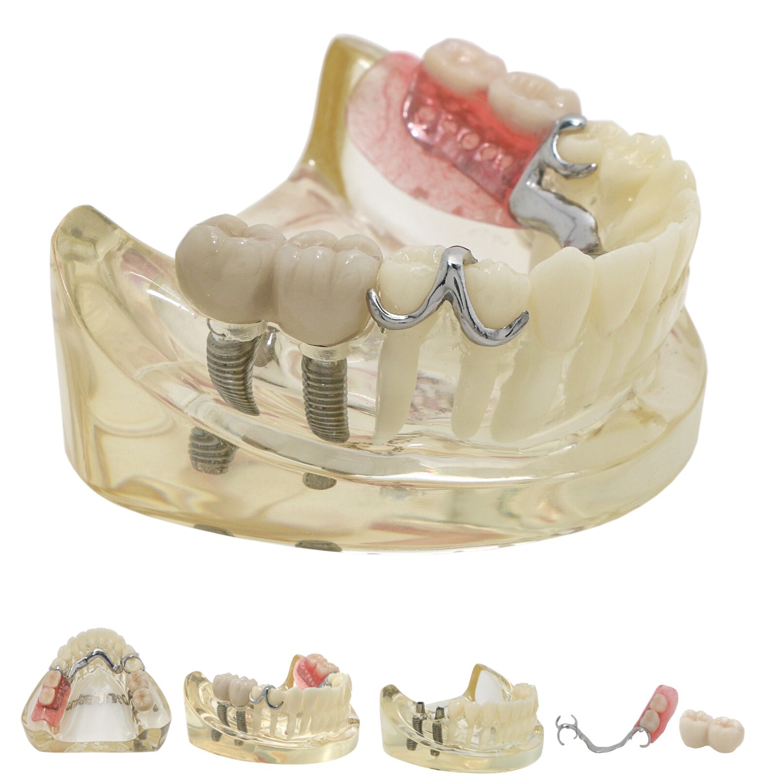 Dental Implant Model Upper Lower Jaw Demo All on 4/6 Overdenture treatment model