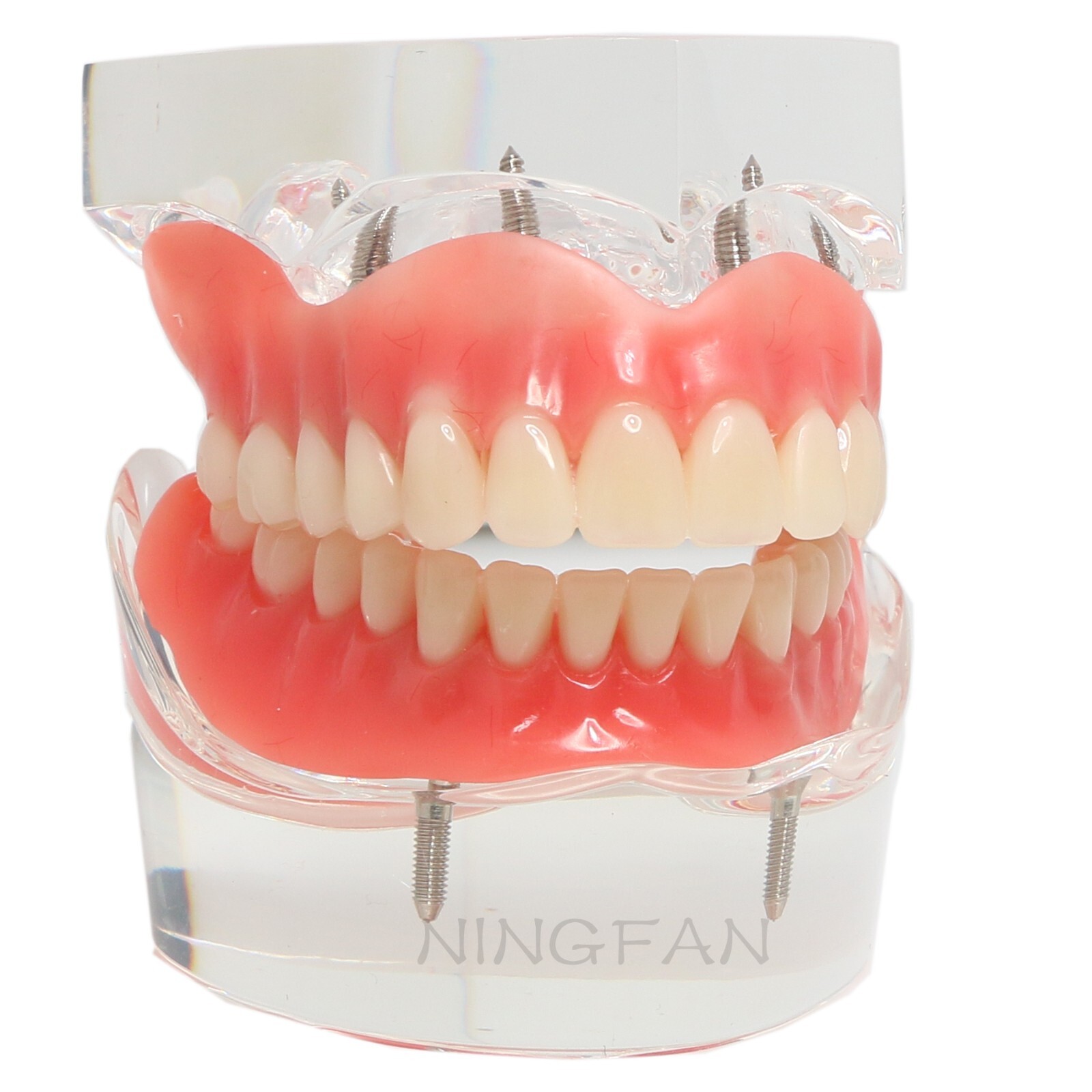Dental Implant Model Upper Lower Jaw Demo All on 4/6 Overdenture treatment model