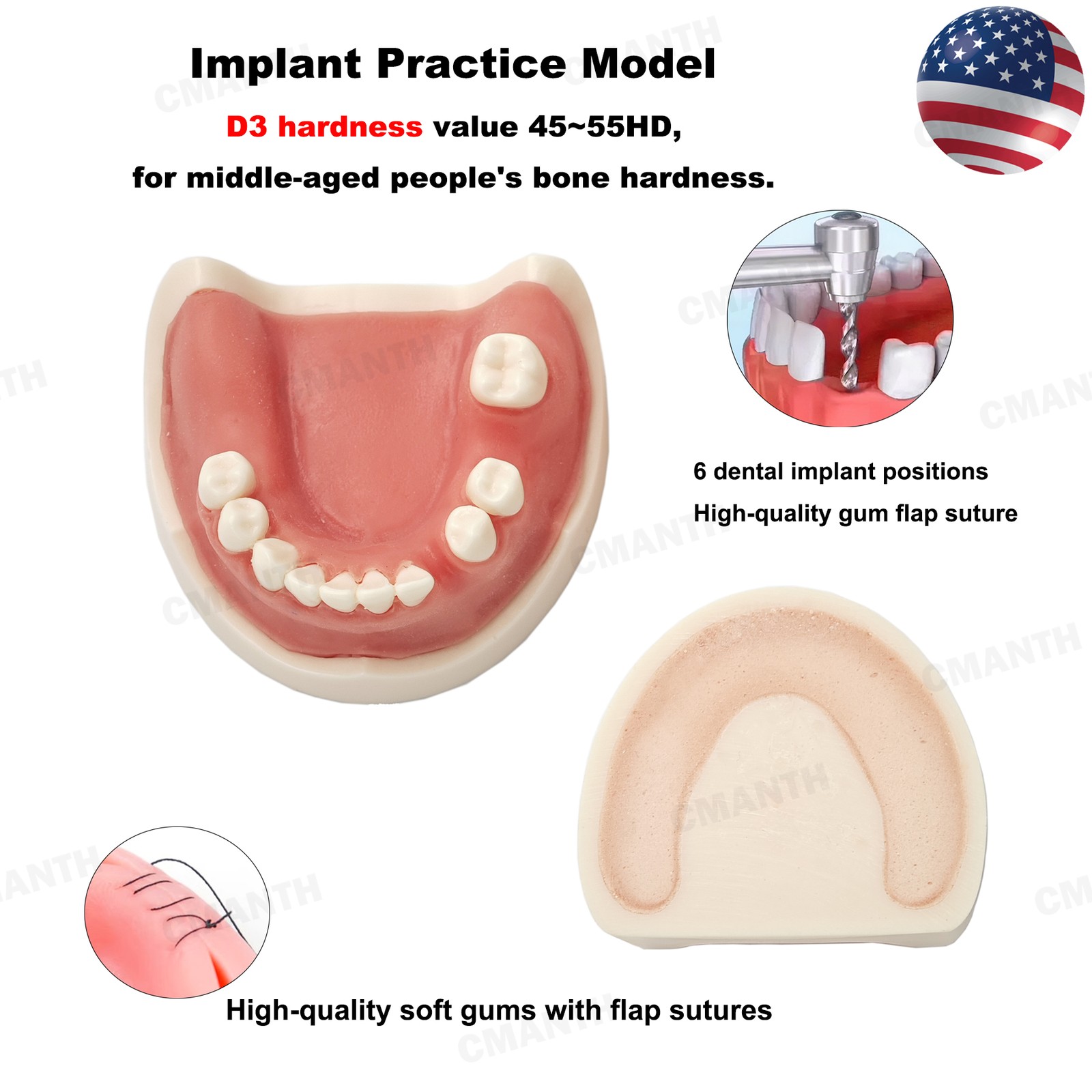 US Dental Model Upper Lower Jaw 4 Overdenture Practice Implant Typodont Demo