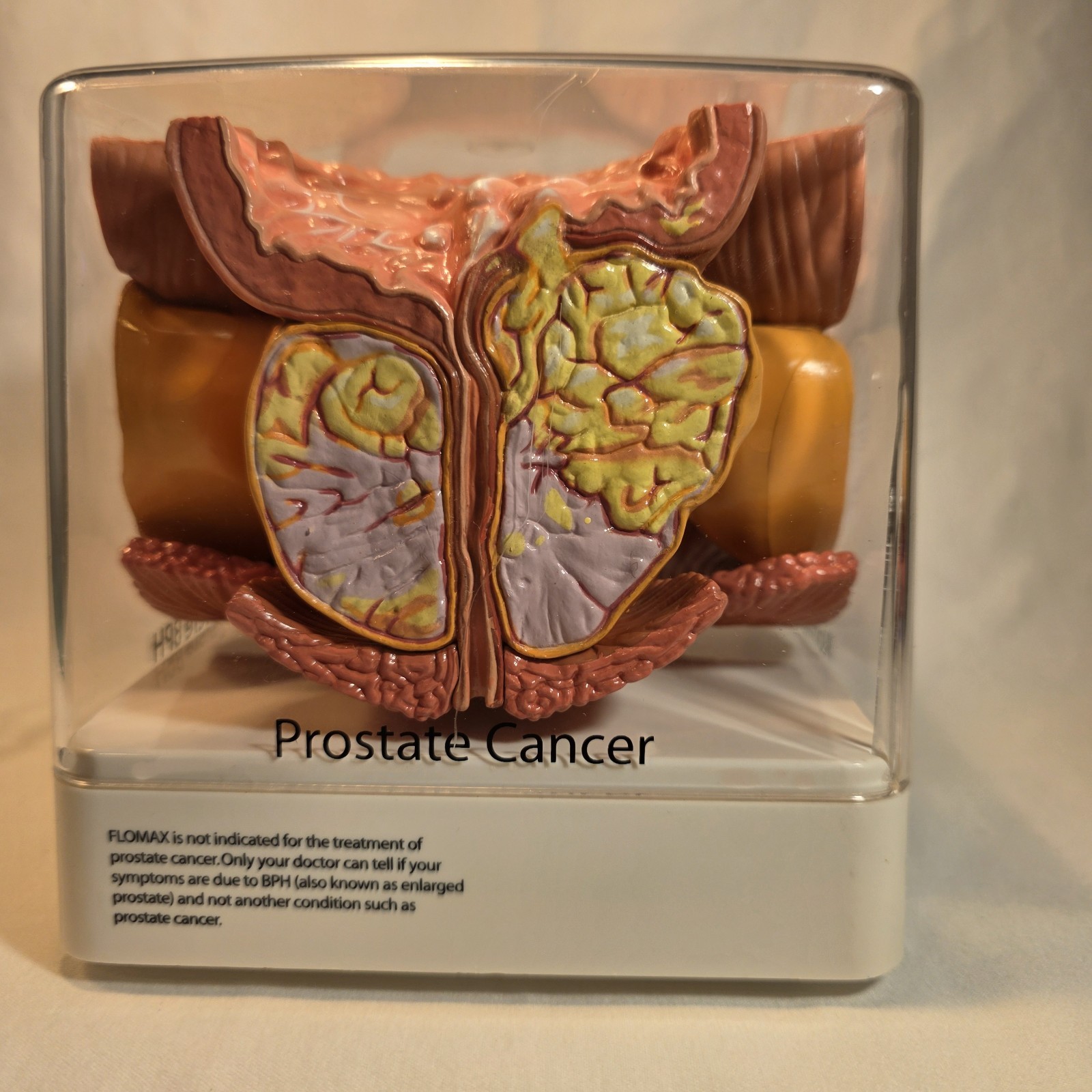 Human Prostate Anatomical Display Model Set Normal Mild/Severe BPH/Cancer