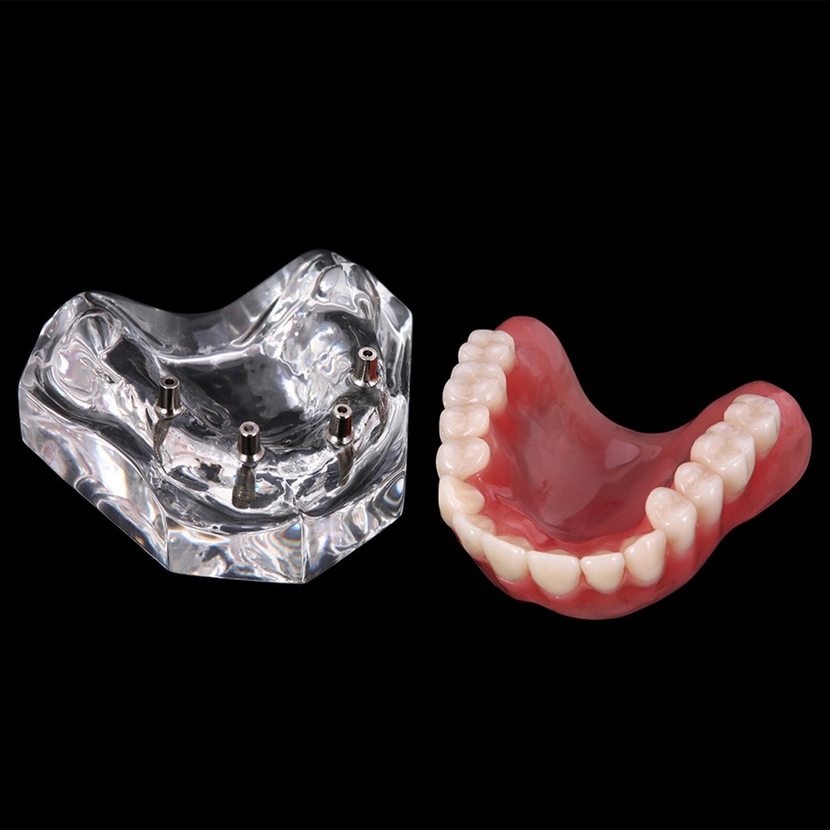 4 Implants Upper Lower Implant Teeth Model Dental Overdenture Restoration Model