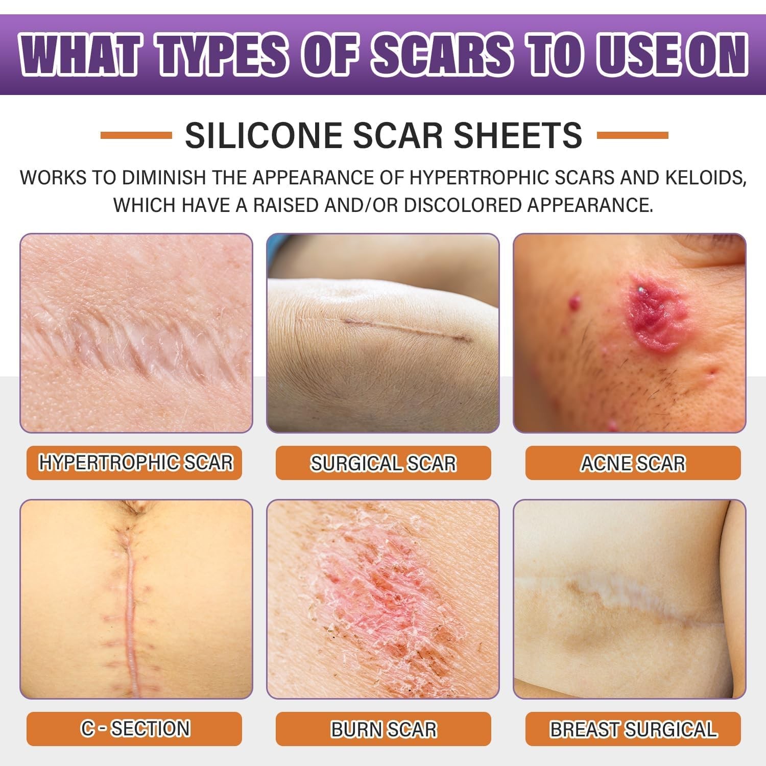 Silicone Scar Sheets, Medical Grade Tape for 1.5M, Beige