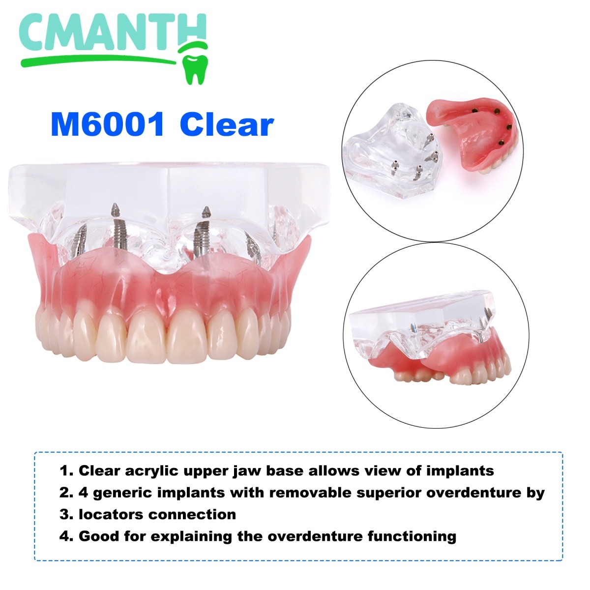 4 Implants Upper Lower Implant Teeth Model Dental Overdenture Restoration Model