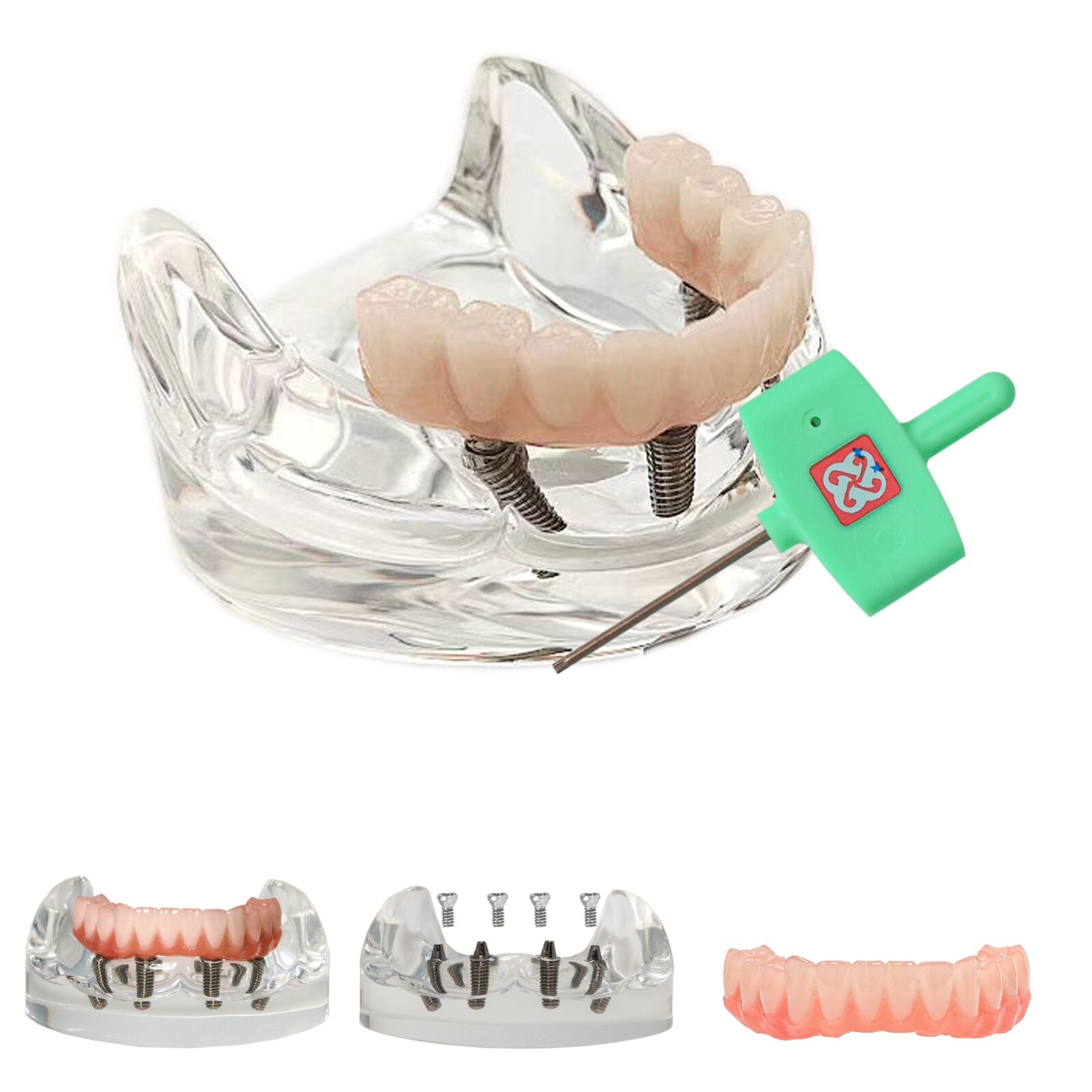Dental Implant Model Upper Lower Jaw Demo All on 4/6 Overdenture treatment model