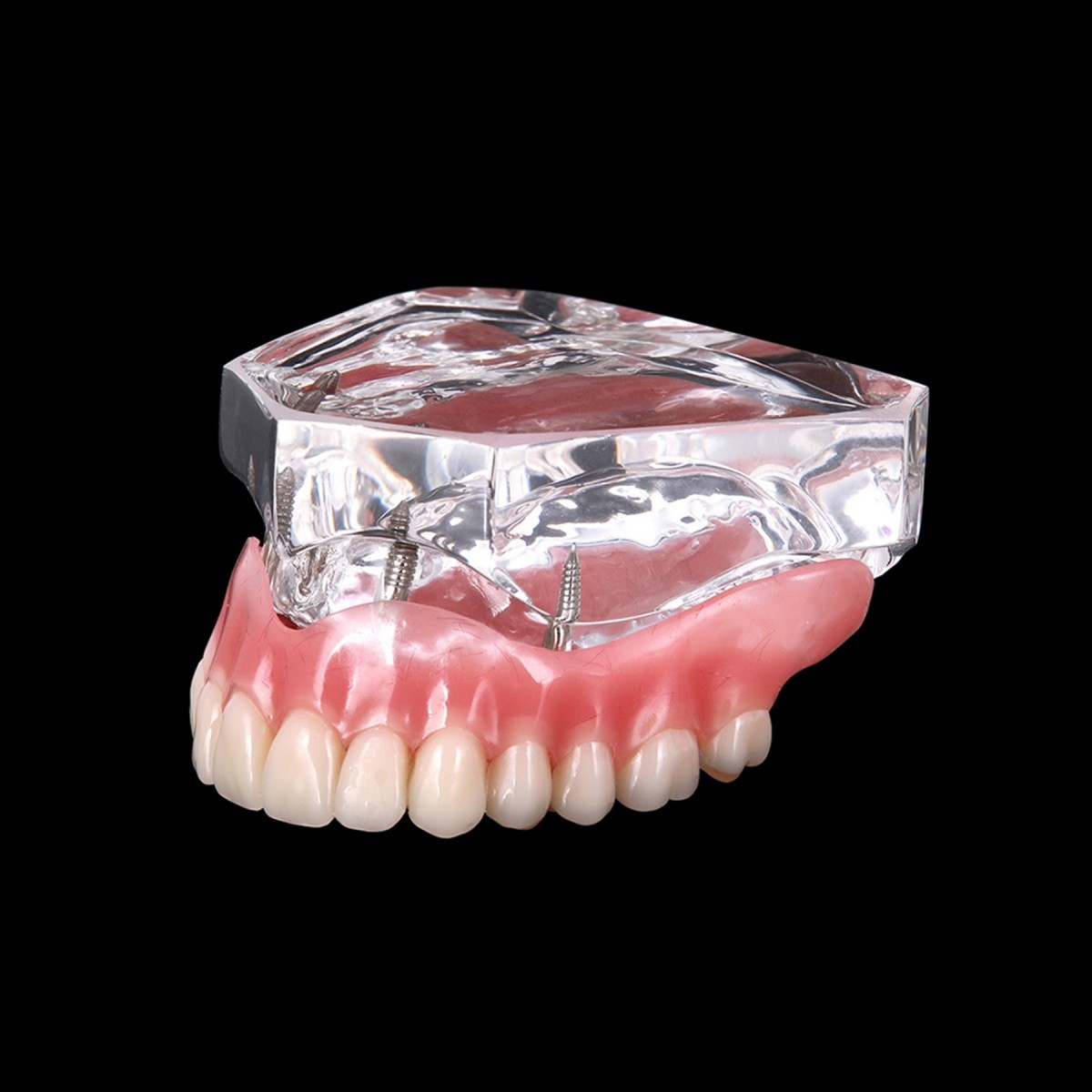 4 Implants Upper Lower Implant Teeth Model Dental Overdenture Restoration Model