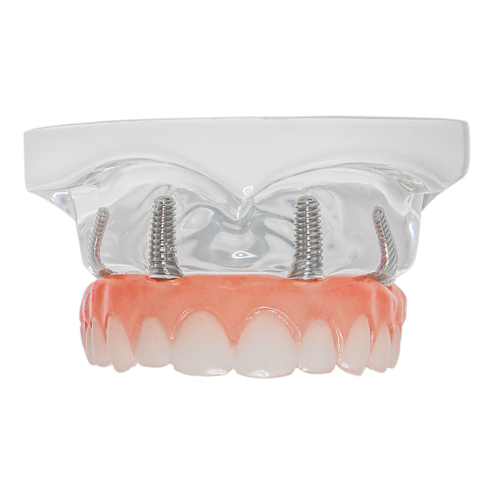 All-on-4/6 Screws Restoration Overdenture Dental Implant Model Upper/Lower Jaw
