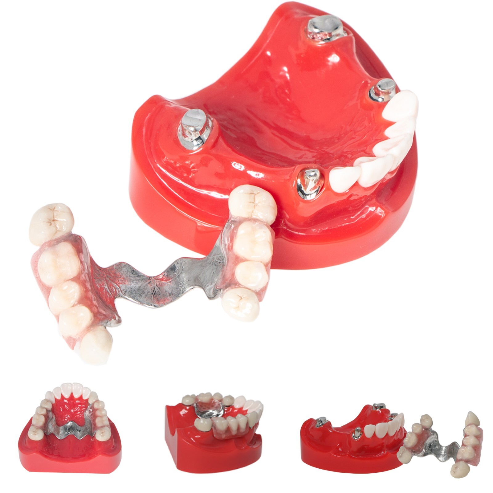Dental Implant Model Upper Lower Jaw Demo All on 4/6 Overdenture treatment model