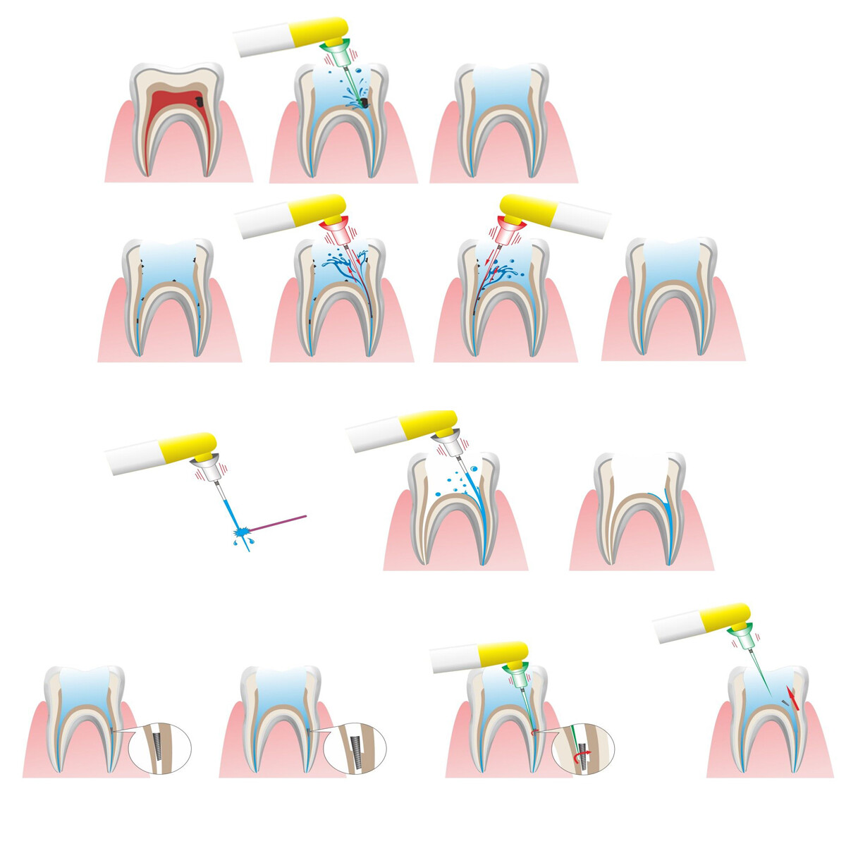 Dental Endodontic Sonic Irrigator Tip Sonic Endo Activator No break Files 1/5PK