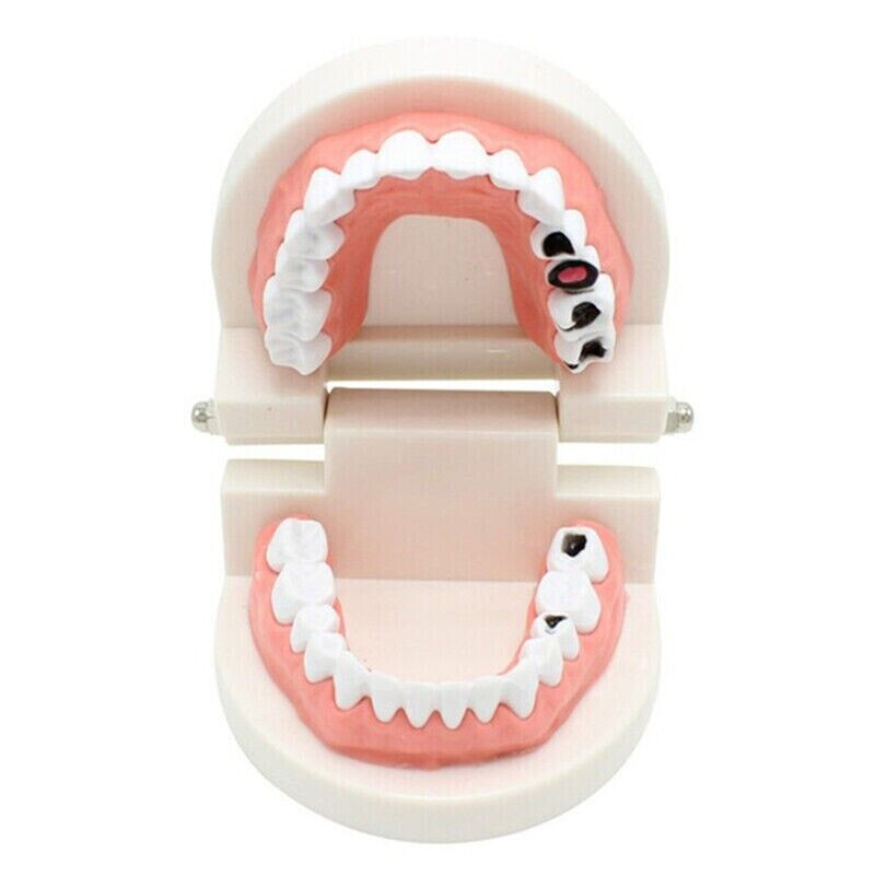 5 Pcs Dental High Quality Material Decay Standard Teeth Teach Adult Caries Model