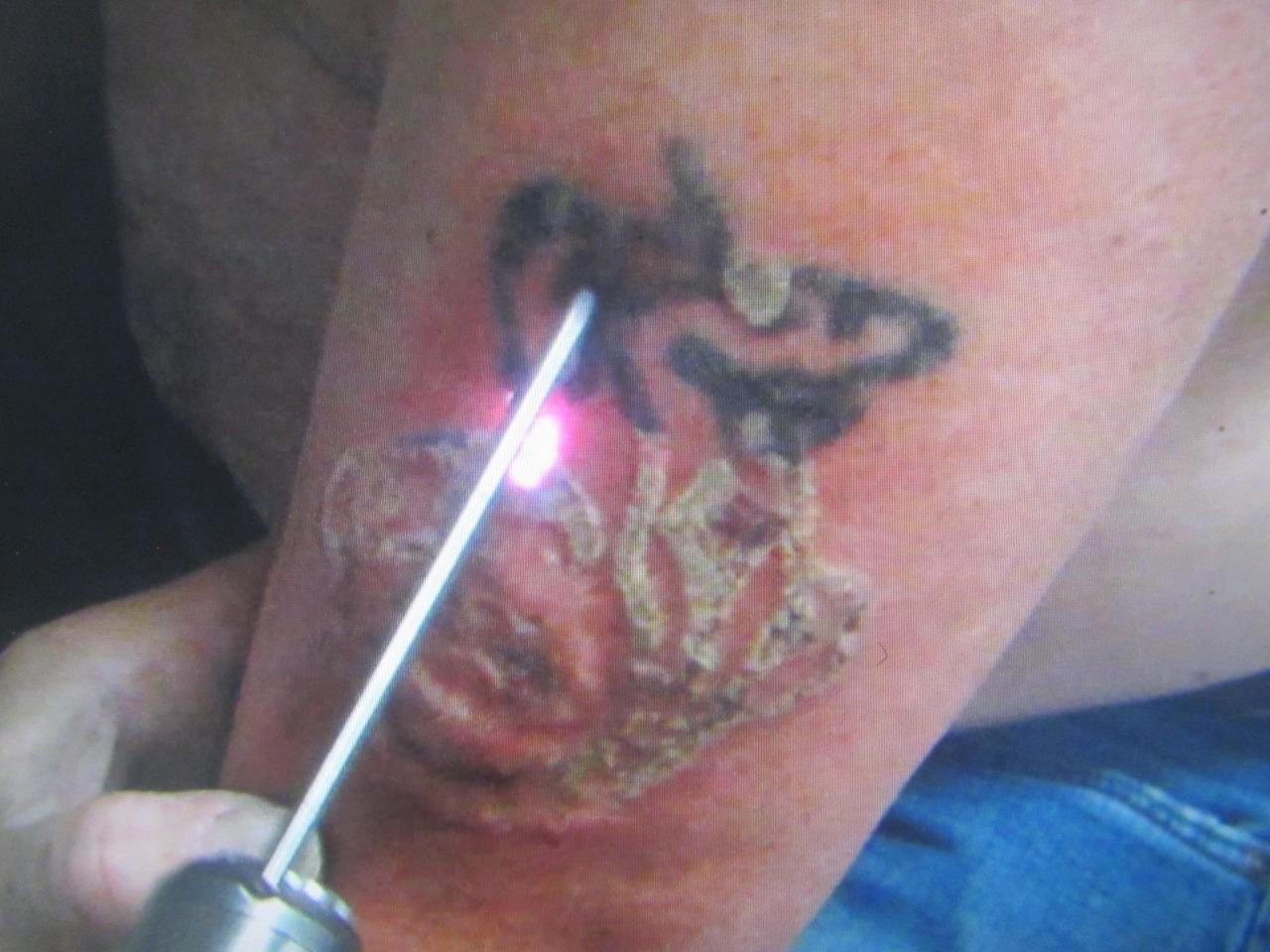 Fotona QX MAX Q-Switched Laser Tattoo Removal w/ 3 Handpiece & Key Nd:YAG 1064nm