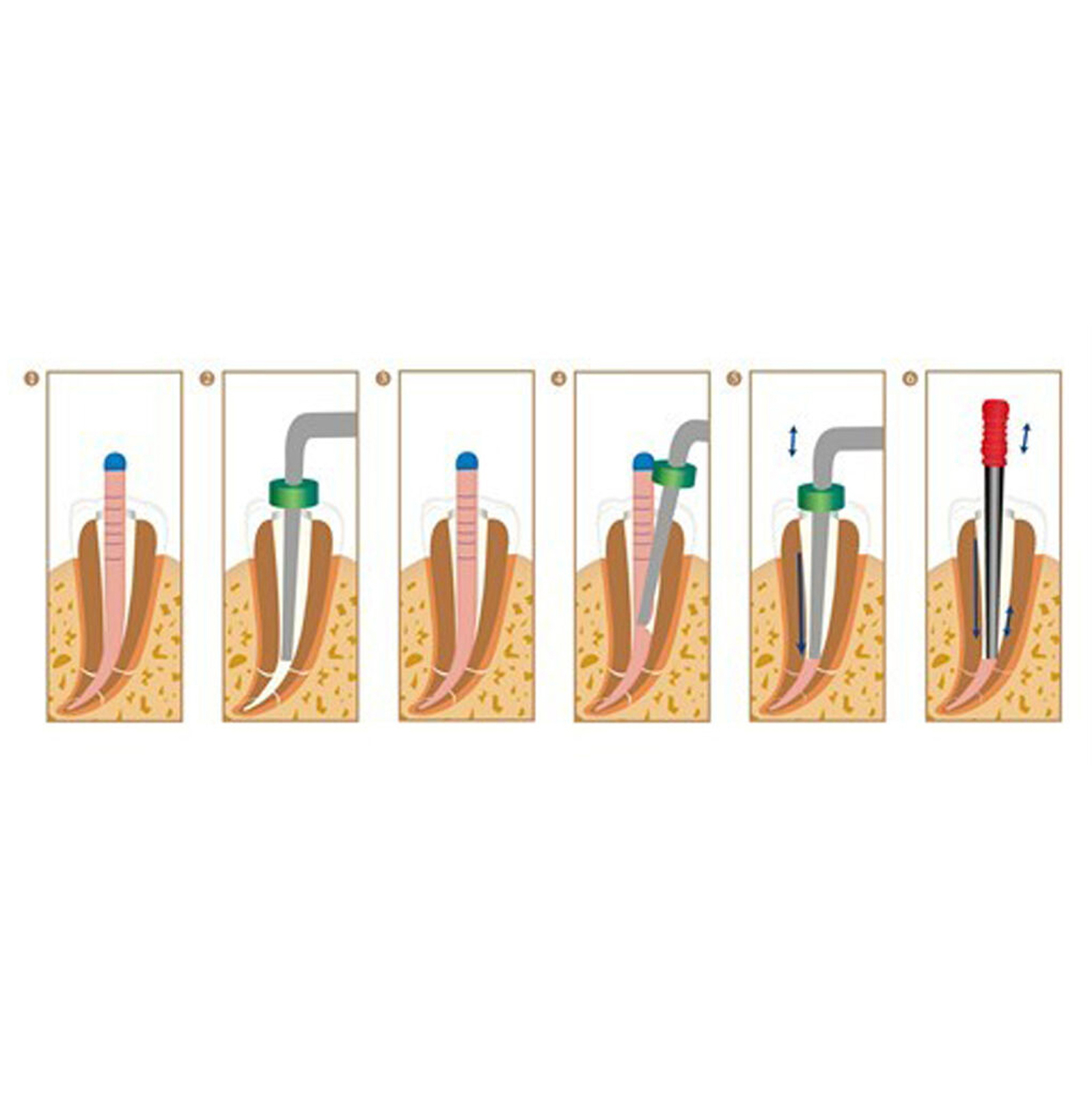 KERR ORIGINAL Sybron Endo Elements Buchanan System B Heat Plugger Obturation Tip