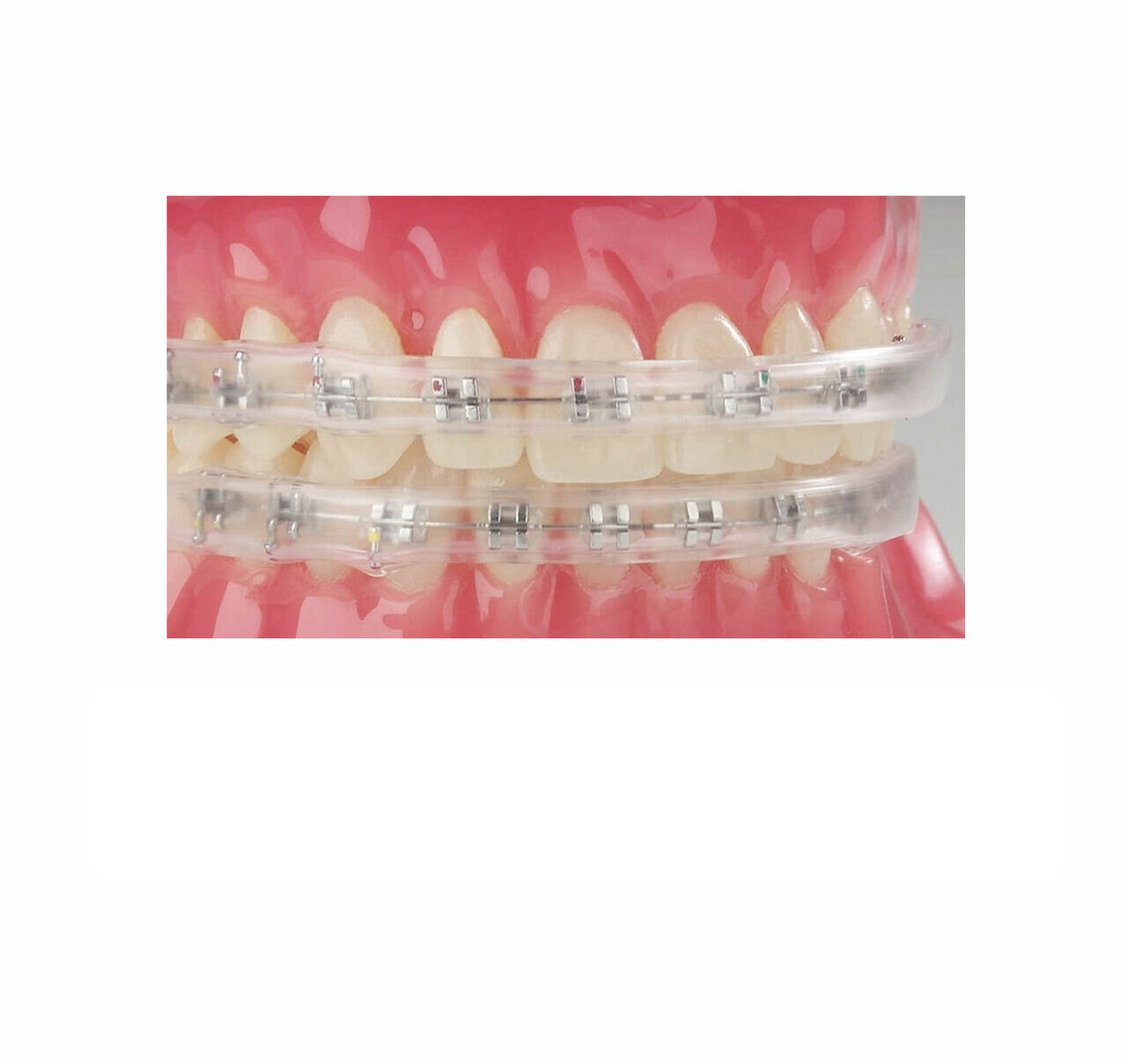 J&J Ortho™ Dental Orthodontic Comfort Protective Lip Bumper Protector for Braces