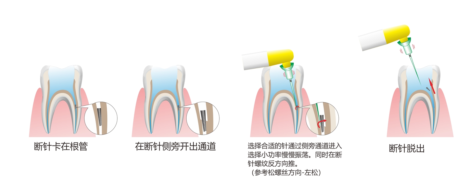Endo Sonic Activator Dental Endodoncia Ultra Irrigator Root Canal Clean 60 Tips