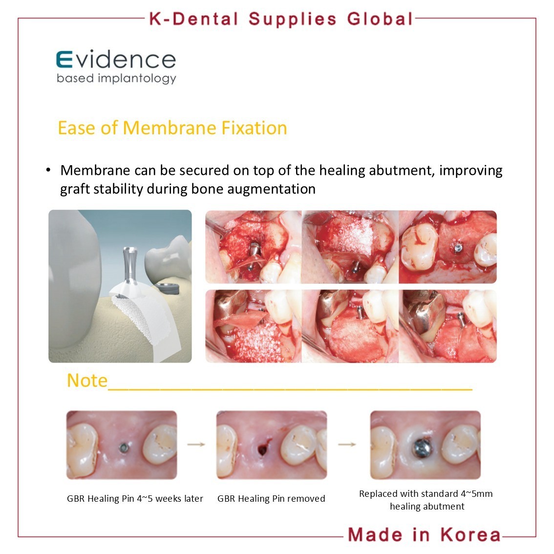 Evidence GBR Healing Pin Abutment