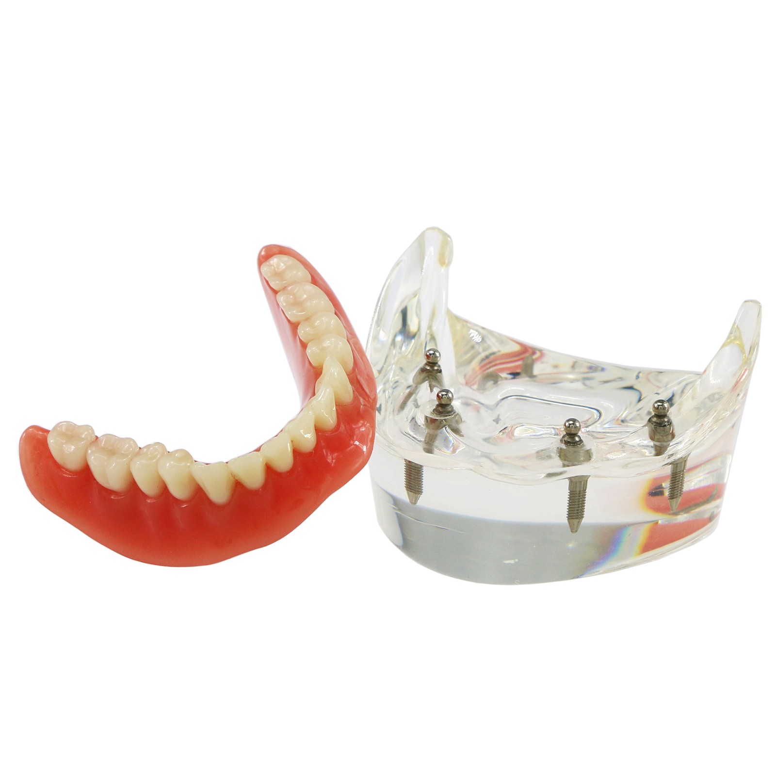 US Dental Implant Teeth Model Overdenture Restoration With4 Implants Upper Lower