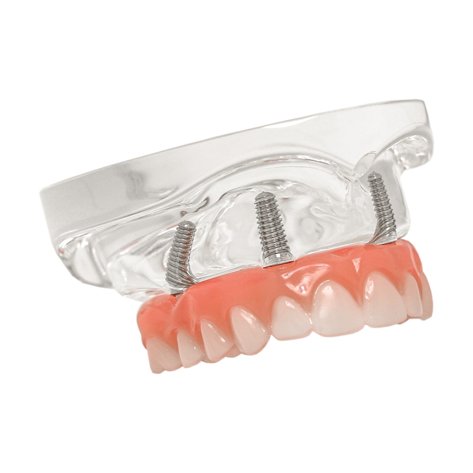 Dental All-on-4 Overdenture Implant Model, Upper/Lower Jaw-Clear,With 4 Screw