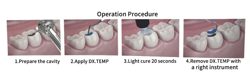 1PC Dental Dx.temp Temporary Light Cure Composite 2.5G/syringe Transparent Color