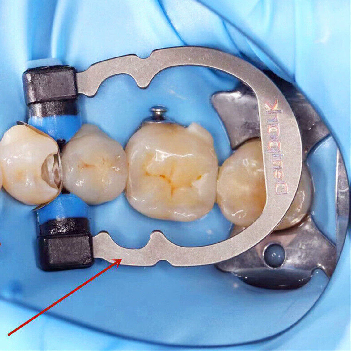 Dental Matrix Sectional Contoured Matrices Nickel Titanium R5 Clamping Ring