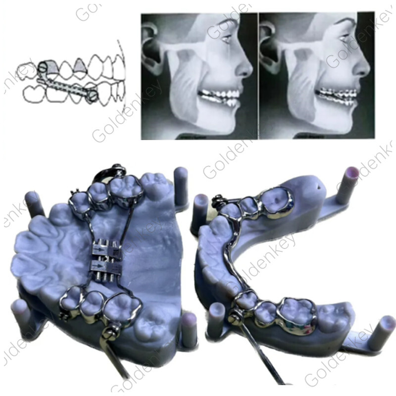 Dental Herbst Appliance Set Device Orthodontic Class II Corrections Dentaurum