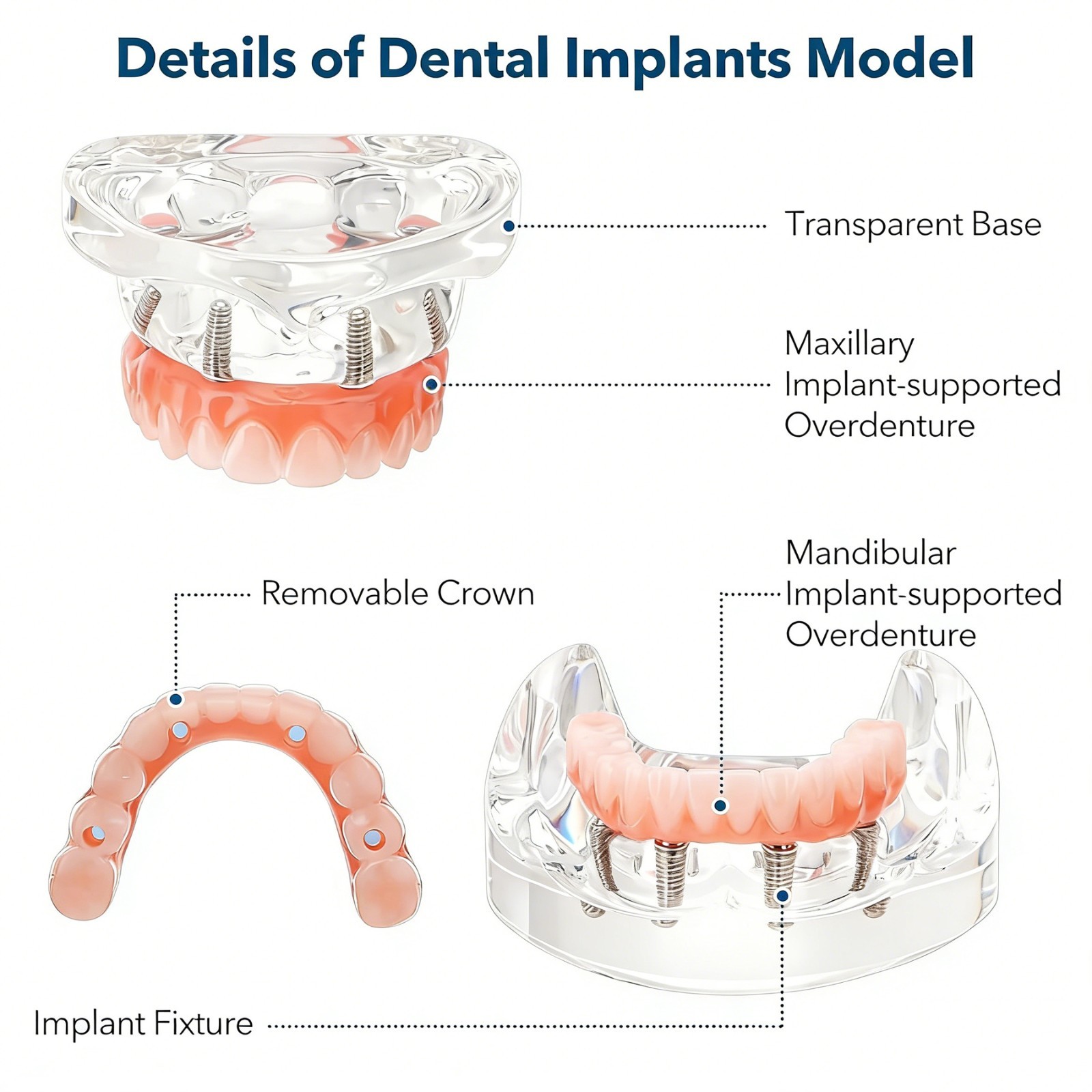 US Dental Implant Overdenture Model All-on-4/6 Upper Jaw Restoration 4/6 Screws