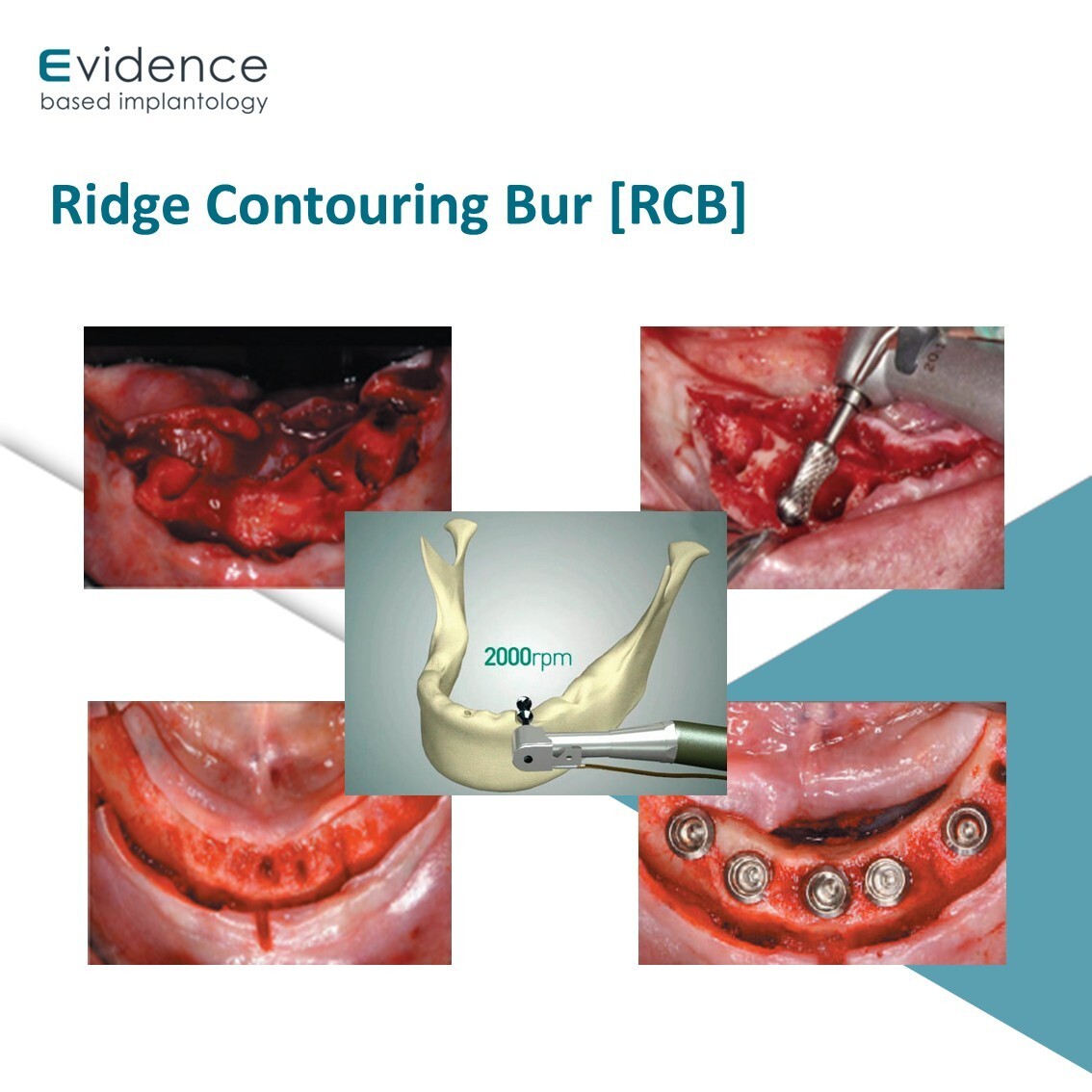 Evidence Implant Ridge Contouring Bur [RCB]