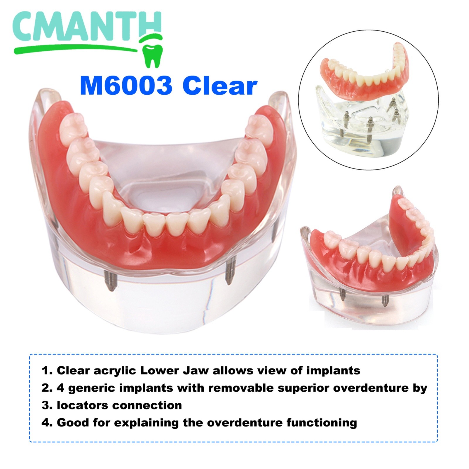 4 Implants Upper Lower Implant Teeth Model Dental Overdenture Restoration Model