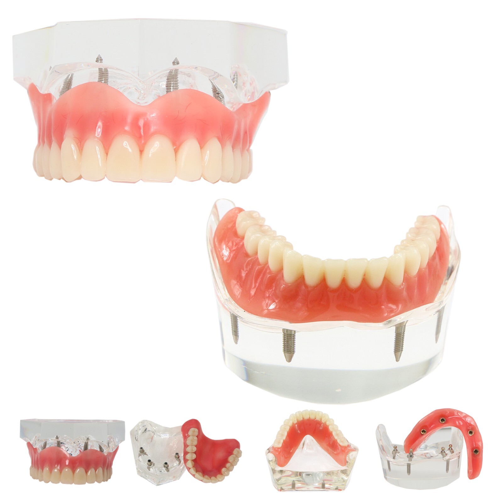 Dental Implant Model Upper Lower Jaw Demo All on 4/6 Overdenture treatment model