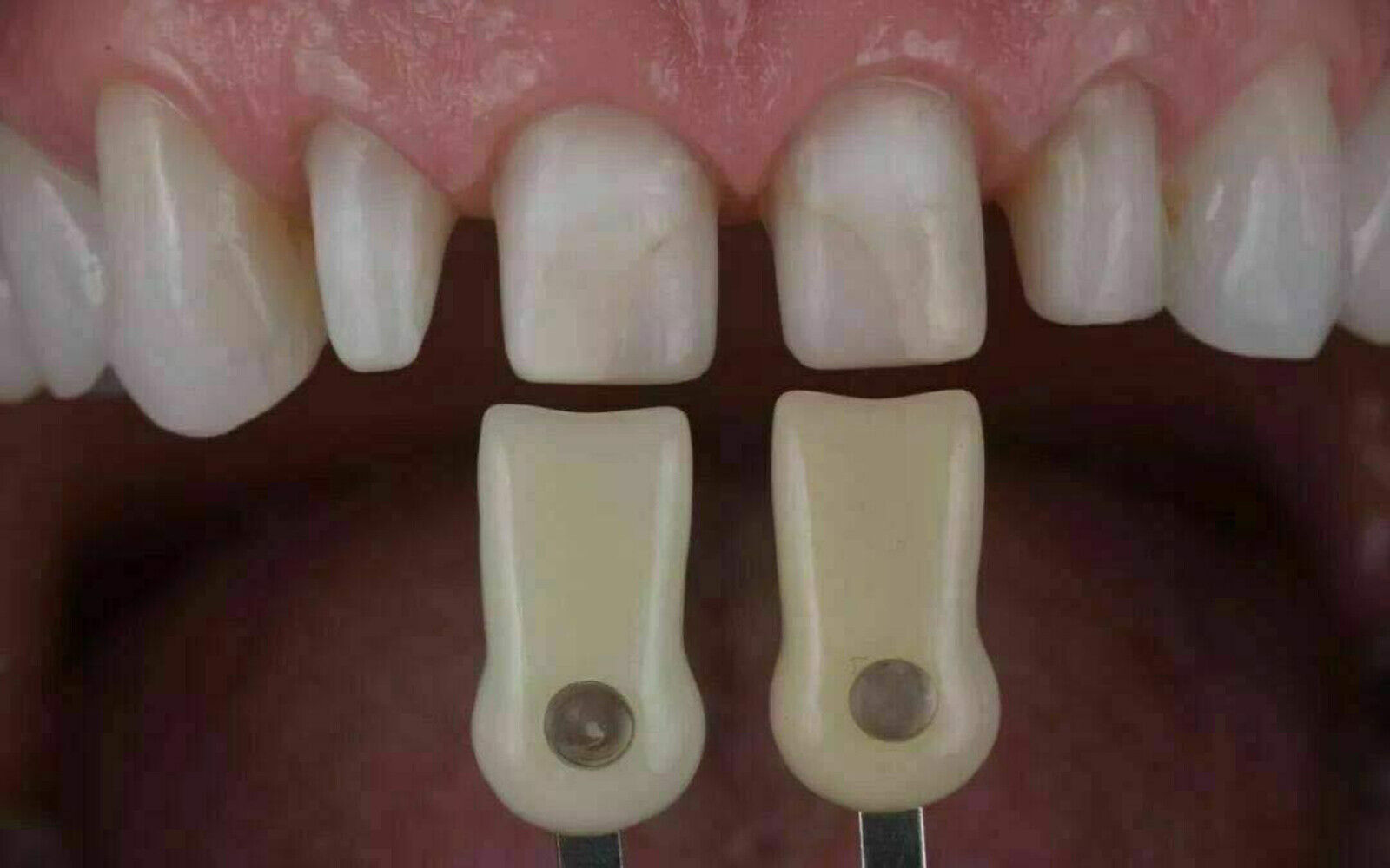 Dental IPS Natural Die Material Shade Guide Ivoclar Vivadent ND1-9 Abutment